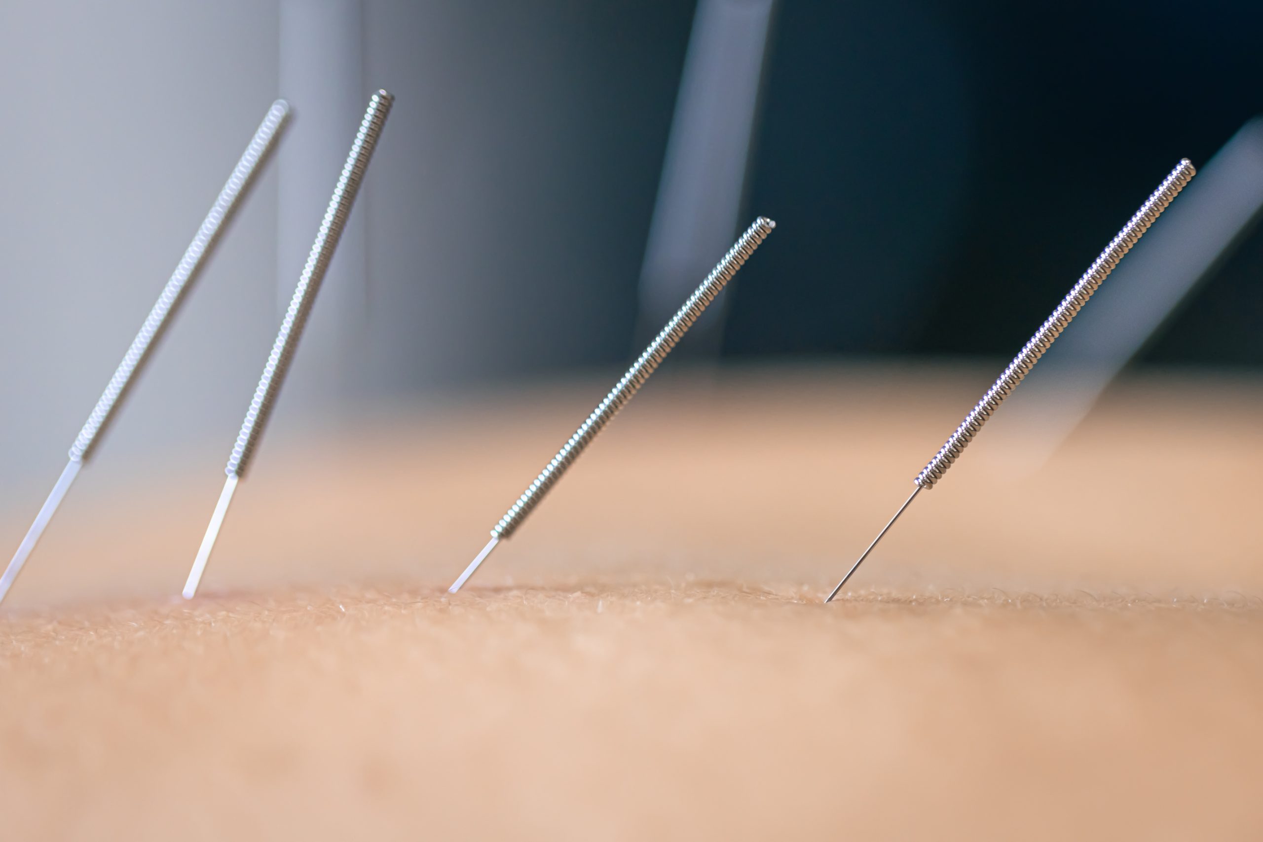 dry needling acupuncture needles patient close up scaled